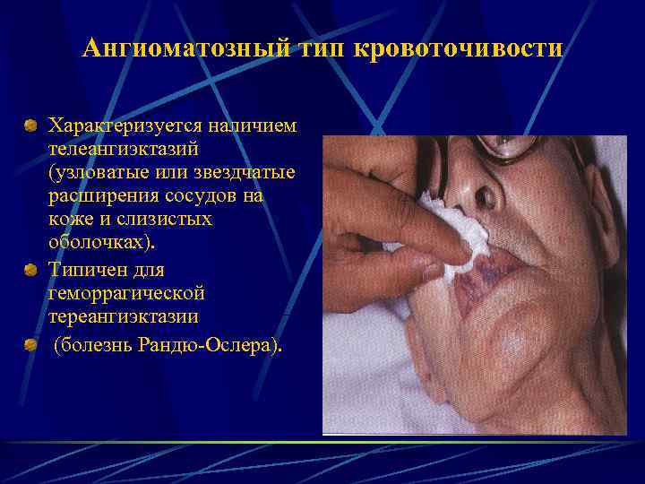 Ангиоматозный тип кровоточивости Характеризуется наличием телеангиэктазий (узловатые или звездчатые расширения сосудов на коже и