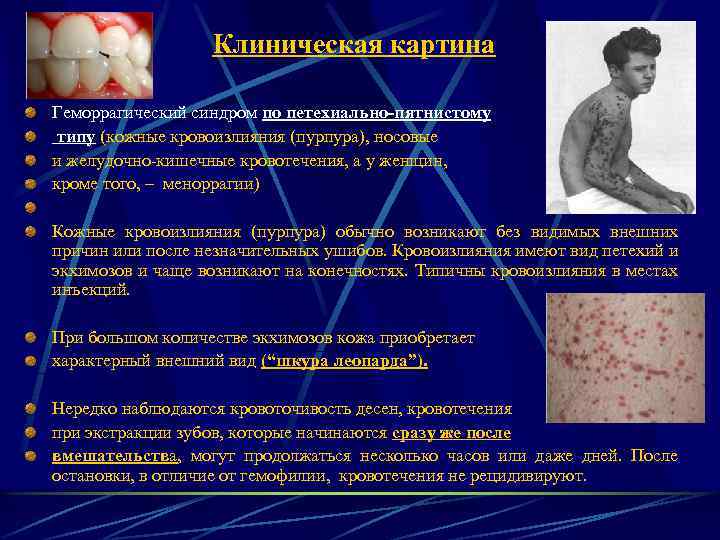 Клиническая картина Геморрагический синдром по петехиально-пятнистому типу (кожные кровоизлияния (пурпура), носовые и желудочно-кишечные кровотечения,