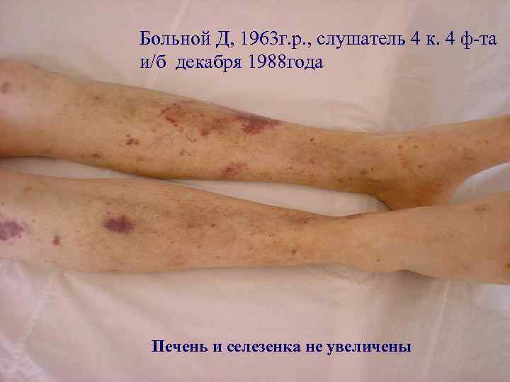 Больной Д, 1963 г. р. , слушатель 4 к. 4 ф-та и/б декабря 1988