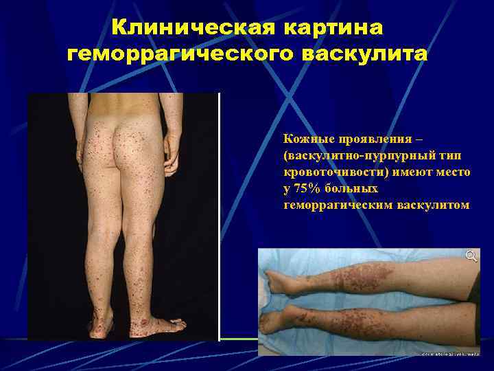 Клиническая картина геморрагического васкулита Кожные проявления – (васкулитно-пурпурный тип кровоточивости) имеют место у 75%