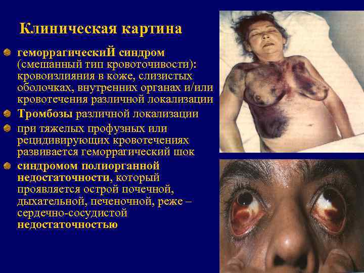 Клиническая картина геморрагически. Й синдром (смешанный тип кровоточивости): кровоизлияния в коже, слизистых оболочках,