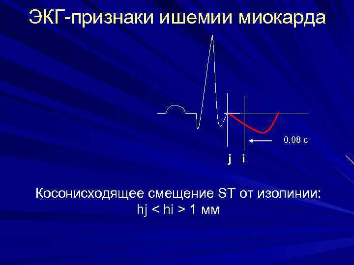 ЭКГ-признаки ишемии миокарда 0, 08 с j i Косонисходящее смещение ST от изолинии: hj