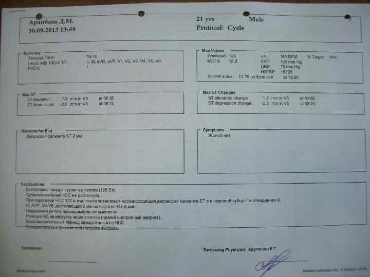 ЭКГ-признаки ишемии миокарда «Корытообразное» смещение ST (нет точек j и i) от изолинии: >