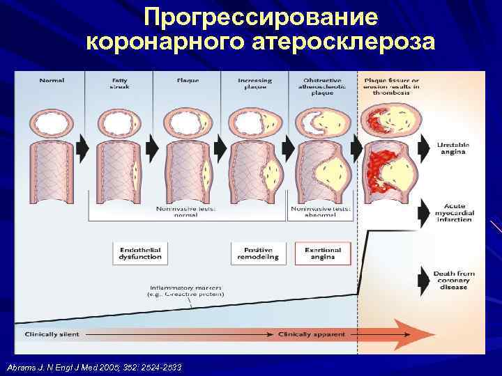 Прогрессирование коронарного атеросклероза Abrams J. N Engl J Med 2005; 352: 2524 -2533 