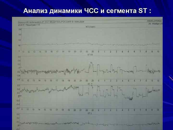 Анализ динамики ЧСС и сегмента ST : 
