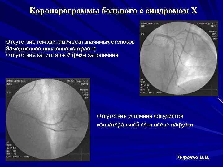 Коронарограммы больного с синдромом Х Отсутствие гемодинамически значимых стенозов Замедленное движение контраста Отсутствие капиллярной