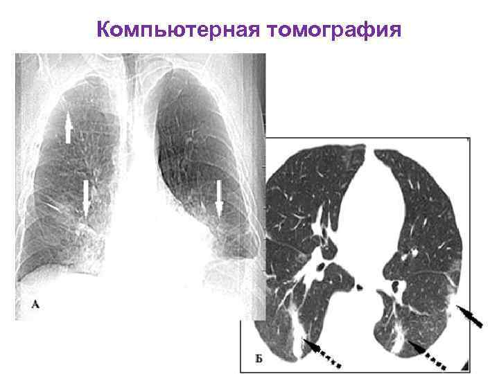Пневмония на кт легких фото