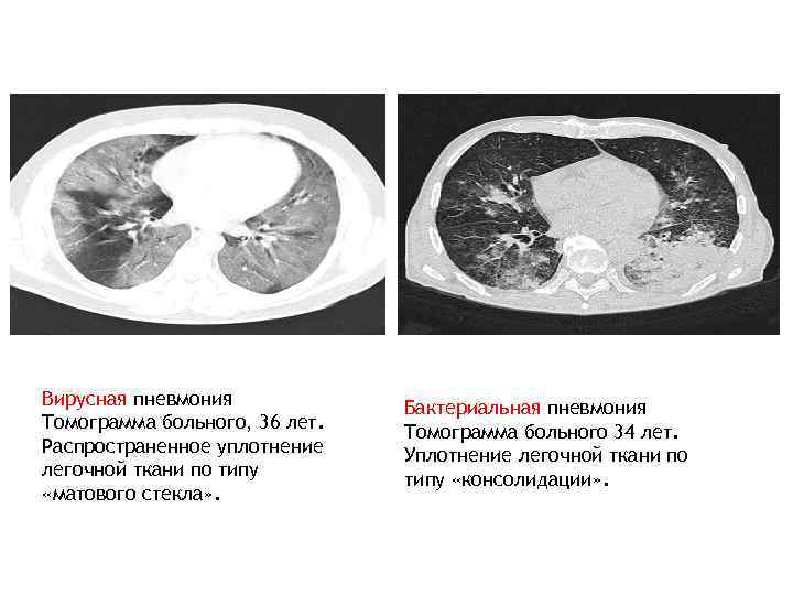 Вирусная пневмония Томограмма больного, 36 лет. Распространенное уплотнение легочной ткани по типу «матового стекла»