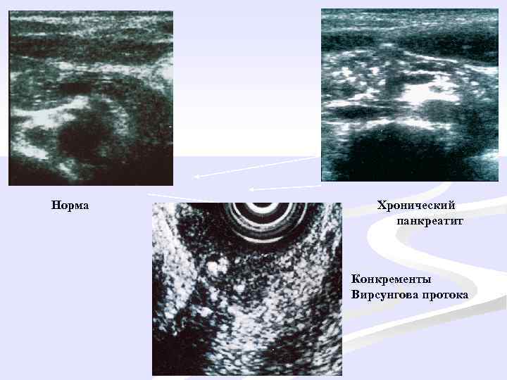 Норма Хронический панкреатит Конкременты Вирсунгова протока 