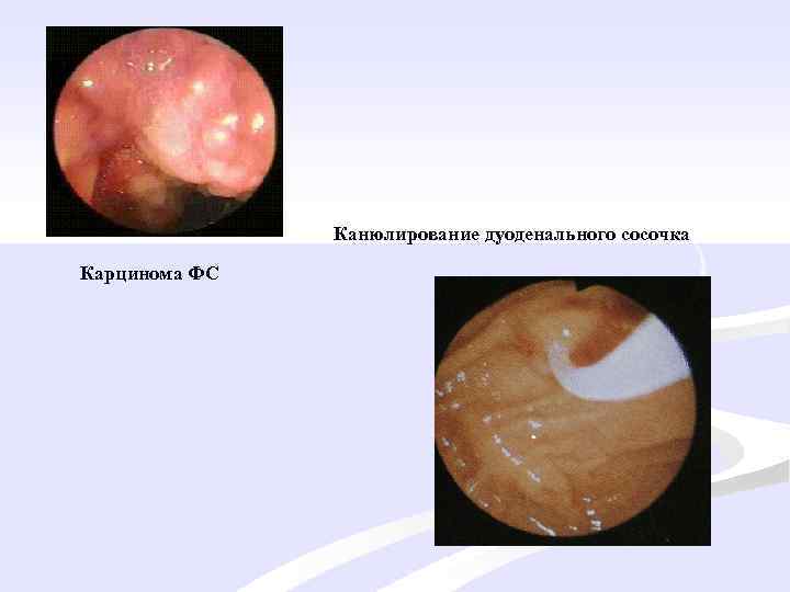 Канюлирование дуоденального сосочка Карцинома ФС 