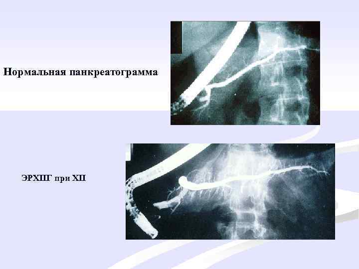 Нормальная панкреатограмма ЭРХПГ при ХП 