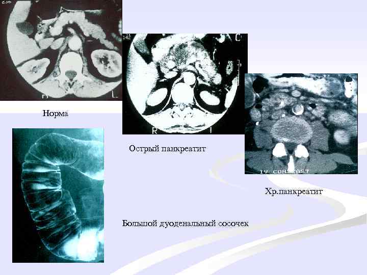 Норма Острый панкреатит Хр. панкреатит Большой дуоденальный сосочек 