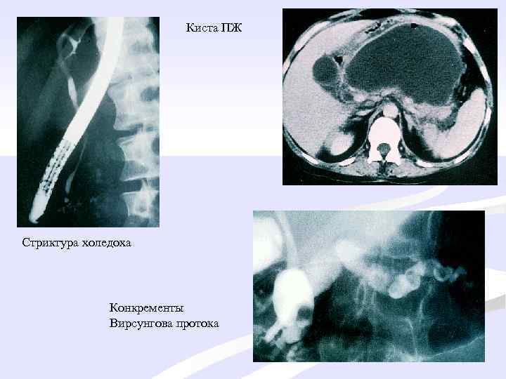 Киста ПЖ Стриктура холедоха Конкременты Вирсунгова протока 