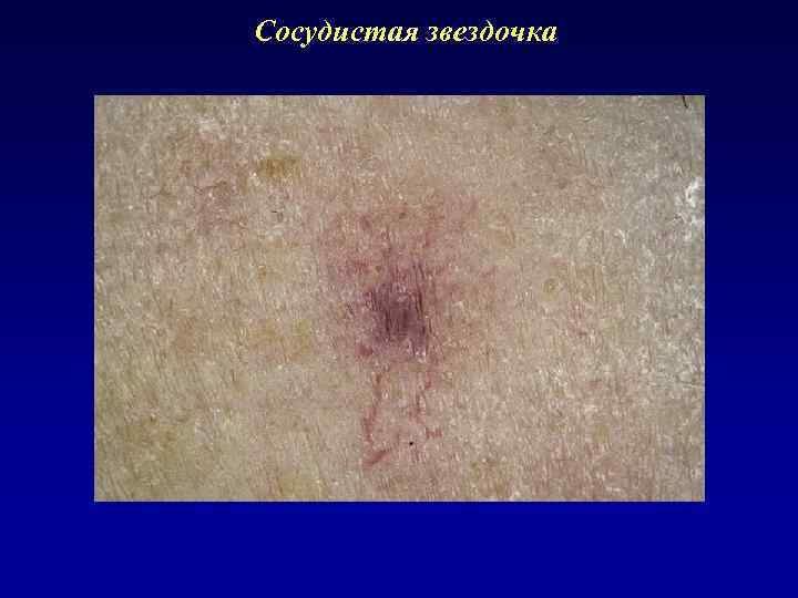 Сосудистая звездочка 