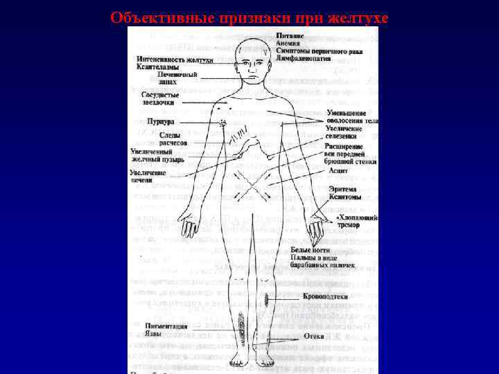 Объективные признаки при желтухе 
