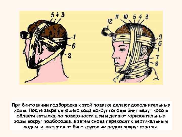 Повязка на один глаз начинается закрепляющим ходом вокруг головы. С затылка бинт ведут под