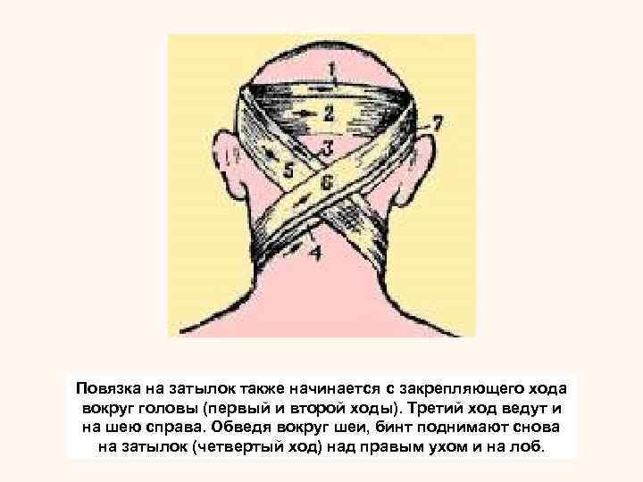 Повязки на голову и шею. Наложение крестообразной повязки на затылочную область. Крестообразная повязка на затылок алгоритм. Бинтовая повязка на шею. Крестообразная повязка на затылок и шею.