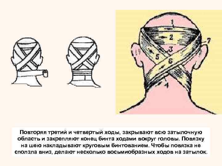 Повязки на голову и шею. Повязка на шею. Повязка на шею бинтом. Наложение повязки на шею. Повязка на затылочную область.