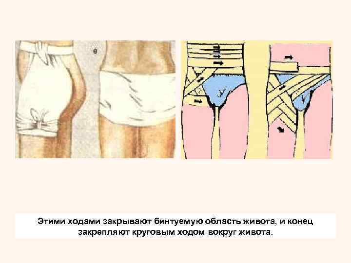 Спиральная повязка на палец начинается круговым ходом на запястье.  Отсюда бинт ведут по