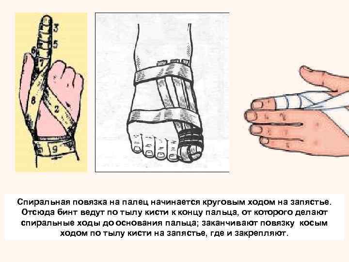 Спиральную повязку можно наложить на каждый палец  в виде перчатки. При этом на