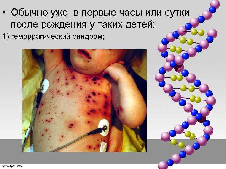  • Обычно уже в первые часы или сутки после рождения у таких детей: