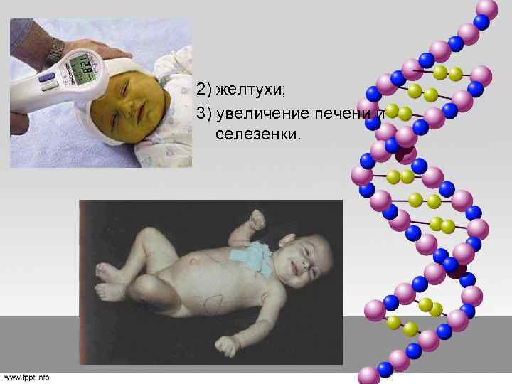 2) желтухи; 3) увеличение печени и селезенки. 