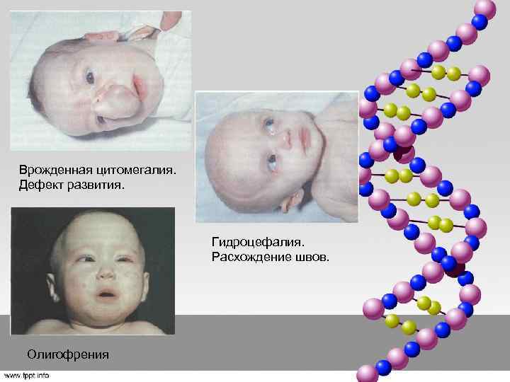 Врожденная цитомегалия. Дефект развития. Гидроцефалия. Расхождение швов. Олигофрения 