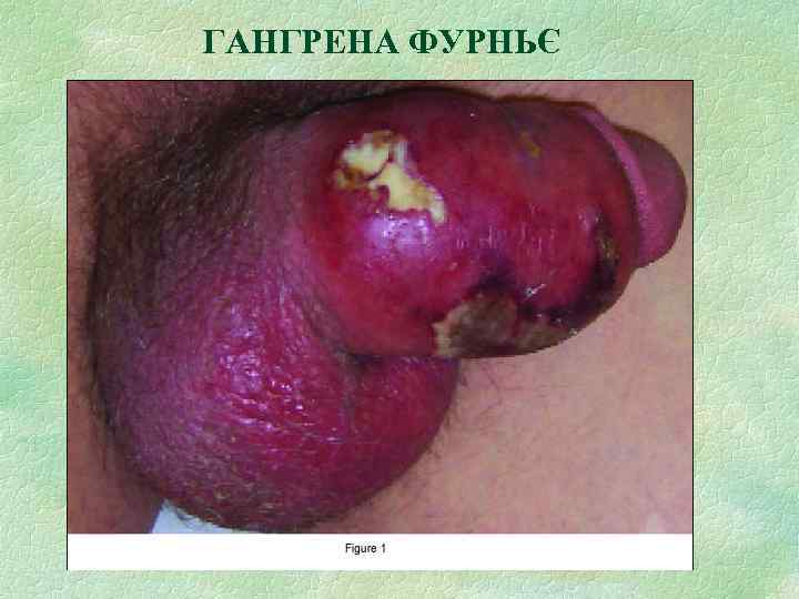 ГАНГРЕНА ФУРНЬЄ 