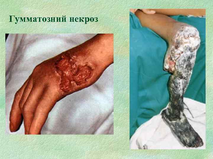 Гумматозний некроз 