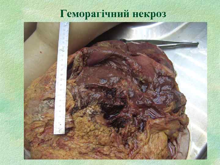 Геморагічний некроз 