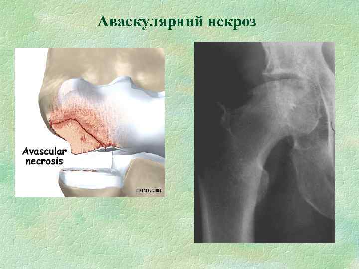 Аваскулярний некроз 