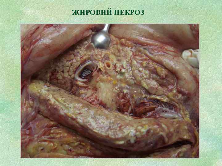 ЖИРОВИЙ НЕКРОЗ 
