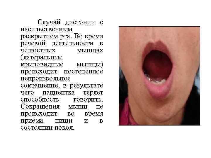  Случай дистонии с насильственным раскрытием рта. Во время речевой деятельности в челюстных мышцах
