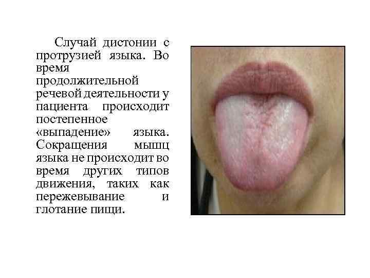  Случай дистонии с протрузией языка. Во время продолжительной речевой деятельности у пациента происходит