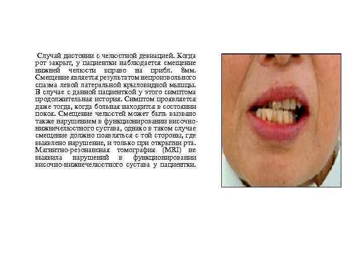  Случай дистонии с челюстной девиацией. Когда рот закрыт, у пациентки наблюдается смещение нижней