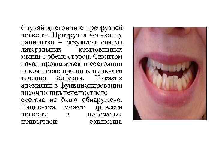  Случай дистонии с протрузией челюсти. Протрузия челюсти у пациентки – результат спазма латеральных