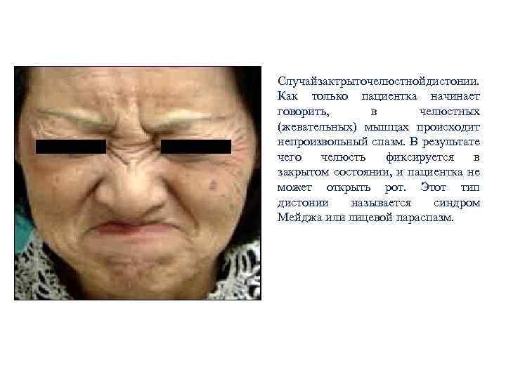 Случай актрыточелюстной истонии. з д Как только пациентка начинает говорить, в челюстных (жевательных) мышцах