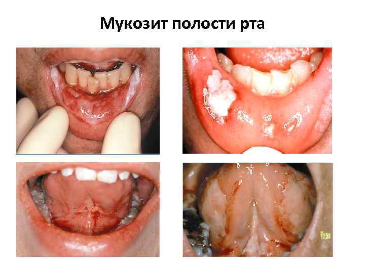 Мукозит полости рта 
