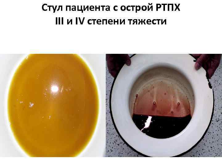 Стул пациента с острой РТПХ III и IV степени тяжести 