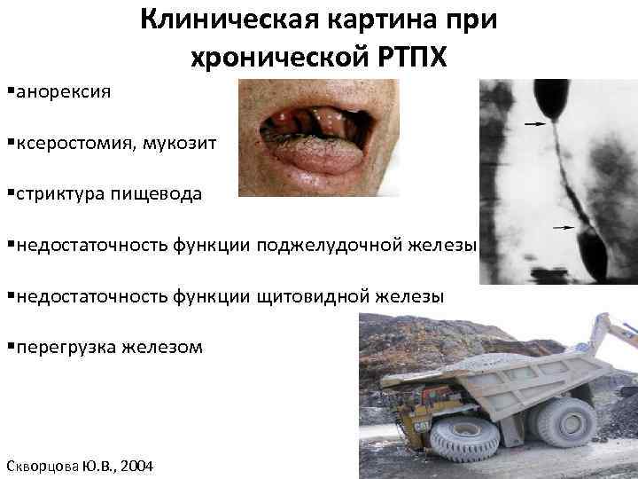 Клиническая картина при хронической РТПХ §анорексия §ксеростомия, мукозит §стриктура пищевода §недостаточность функции поджелудочной железы