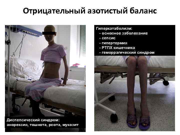 Отрицательный азотистый баланс Гиперкатаболизм: - основное заболевание - сепсис - гипертермия - РТПХ кишечника