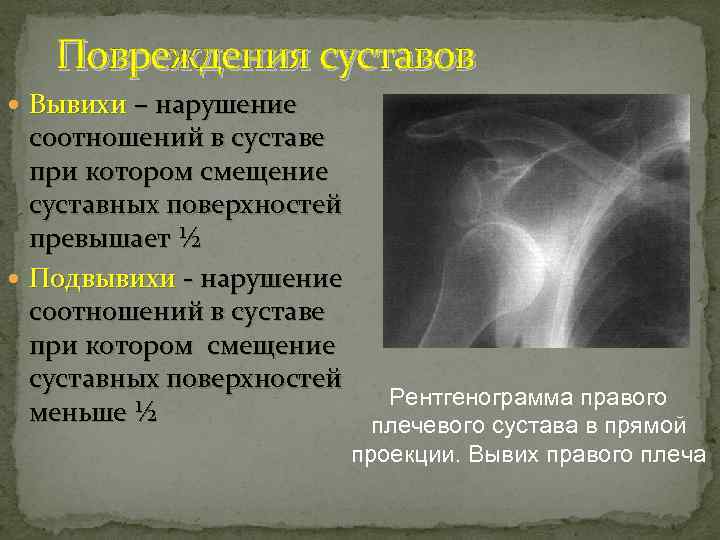Повреждения суставов Вывихи – нарушение соотношений в суставе при котором смещение суставных поверхностей превышает