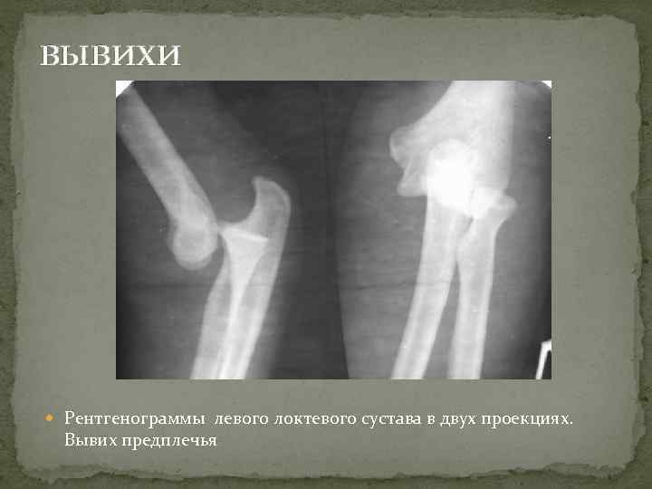вывихи Рентгенограммы левого локтевого сустава в двух проекциях. Вывих предплечья 