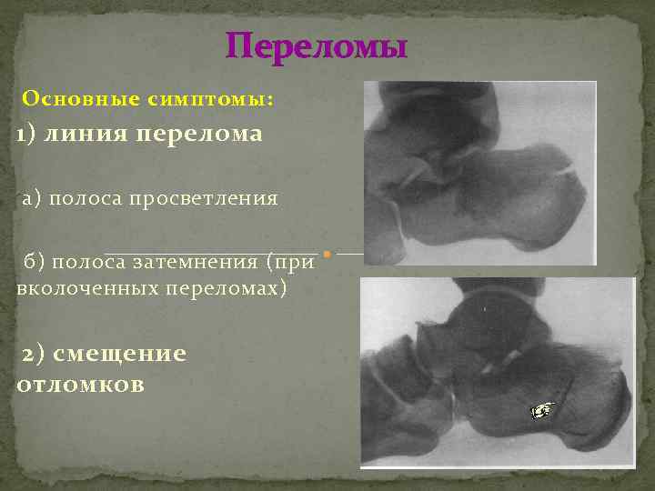 Переломы Основные симптомы: 1) линия перелома а) полоса просветления б) полоса затемнения (при вколоченных