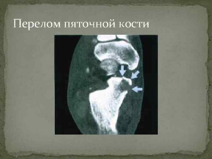 Перелом пяточной кости 