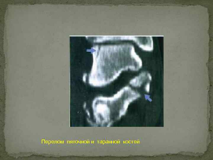 Перелом пяточной и таранной костей 