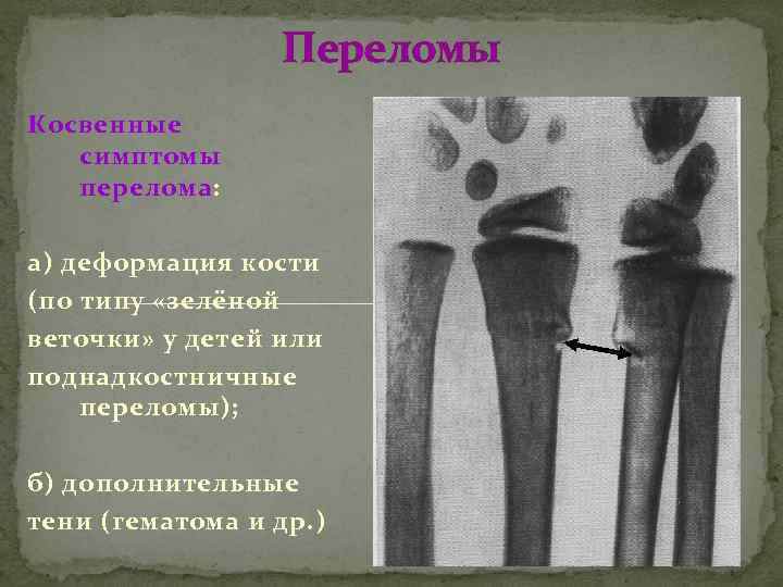 Переломы Косвенные симптомы перелома: а) деформация кости (по типу «зелёной веточки» у детей или