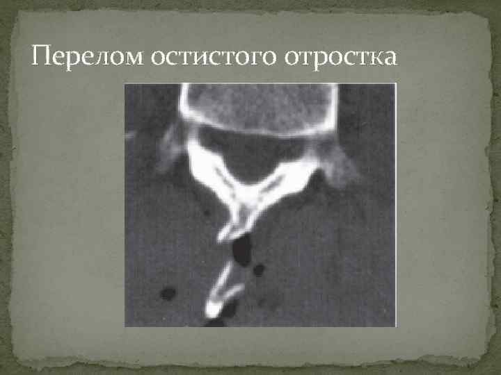 Перелом остистого отростка 