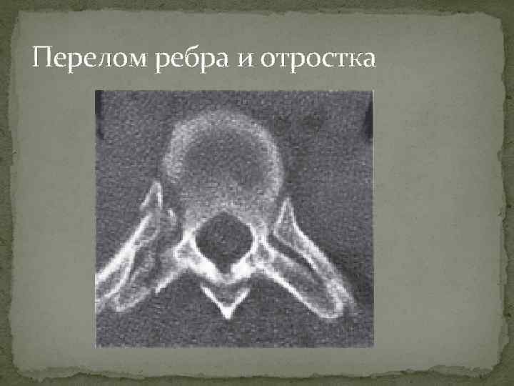 Перелом ребра и отростка 