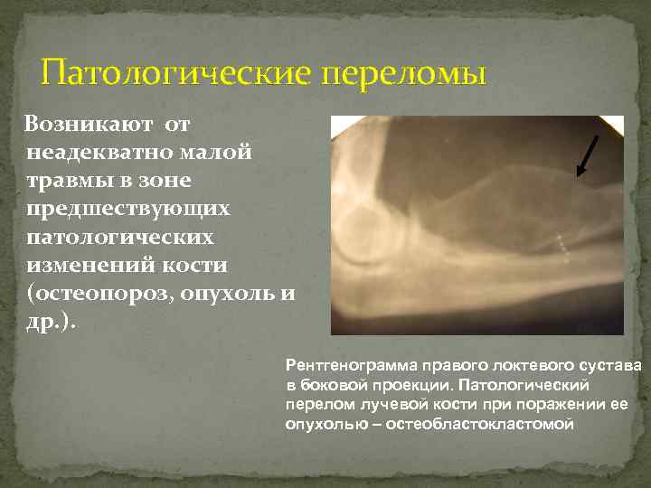 Патологические переломы Возникают от неадекватно малой травмы в зоне предшествующих патологических изменений кости (остеопороз,